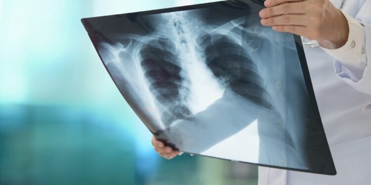 Early lung cancer detection with a machine learning model based on imaging, clinical, and DNA methylation biomarkers