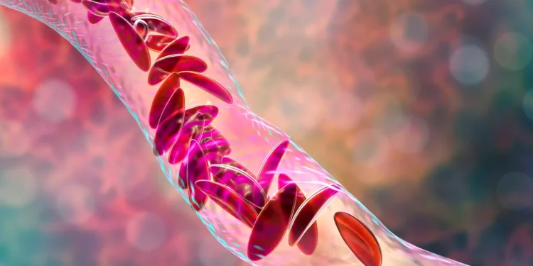 Sickle cell patient dies in Beam study of base editing therapy