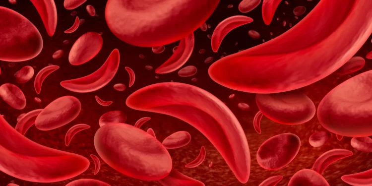 Gene therapy uptake in sickle cell stays slow, despite patient interest