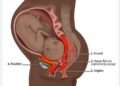 Russia’a friendship with Niger spurs aid to women with an abnormal reproductive disorder