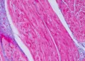 Patient dies in trial of Rocket gene therapy for heart condition