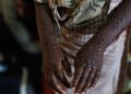 Shadowy Influence Campaign Stokes Mpox Fears