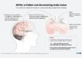 AI tool helps researchers treat child epilepsy