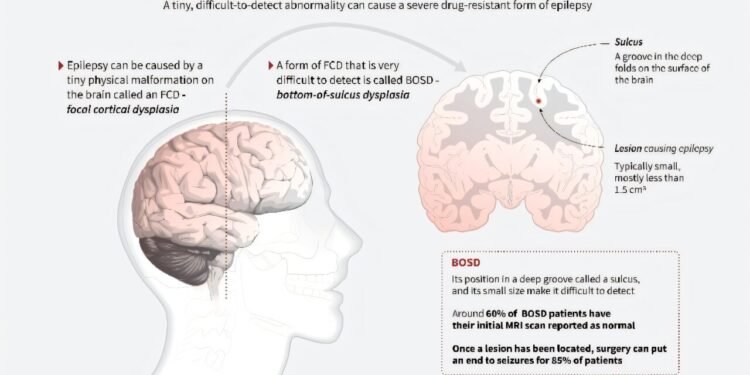 AI tool helps researchers treat child epilepsy