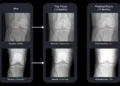 AI turns x-rays into time machines for arthritis care