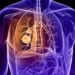 Summit’s dual-acting drug scores lung cancer win