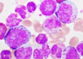 Terns drug shows potential to challenge Novartis’ blockbuster leukemia treatment
