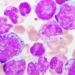Terns drug shows potential to challenge Novartis’ blockbuster leukemia treatment