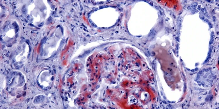 With $130M, Protego pushes forward a new type of amyloidosis drug